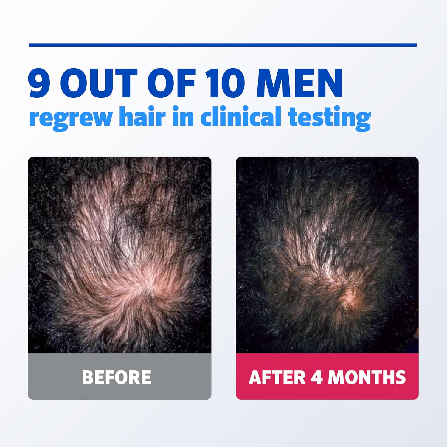 Men’s Rogaine 5% Minoxidil Topical Foam, One Month Supply